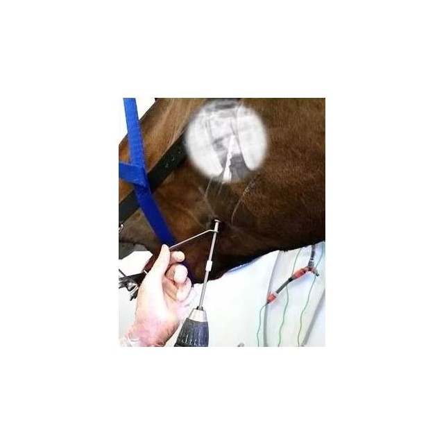 Buccotomy set advanced