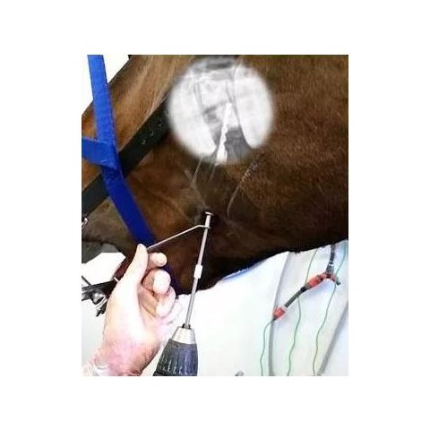 Set buccotomie avancé