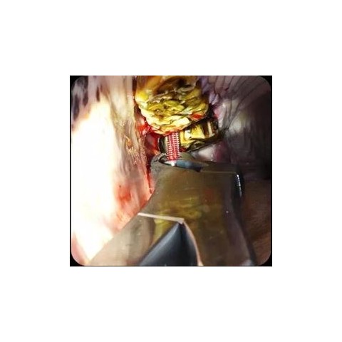 Set buccotomie avancé